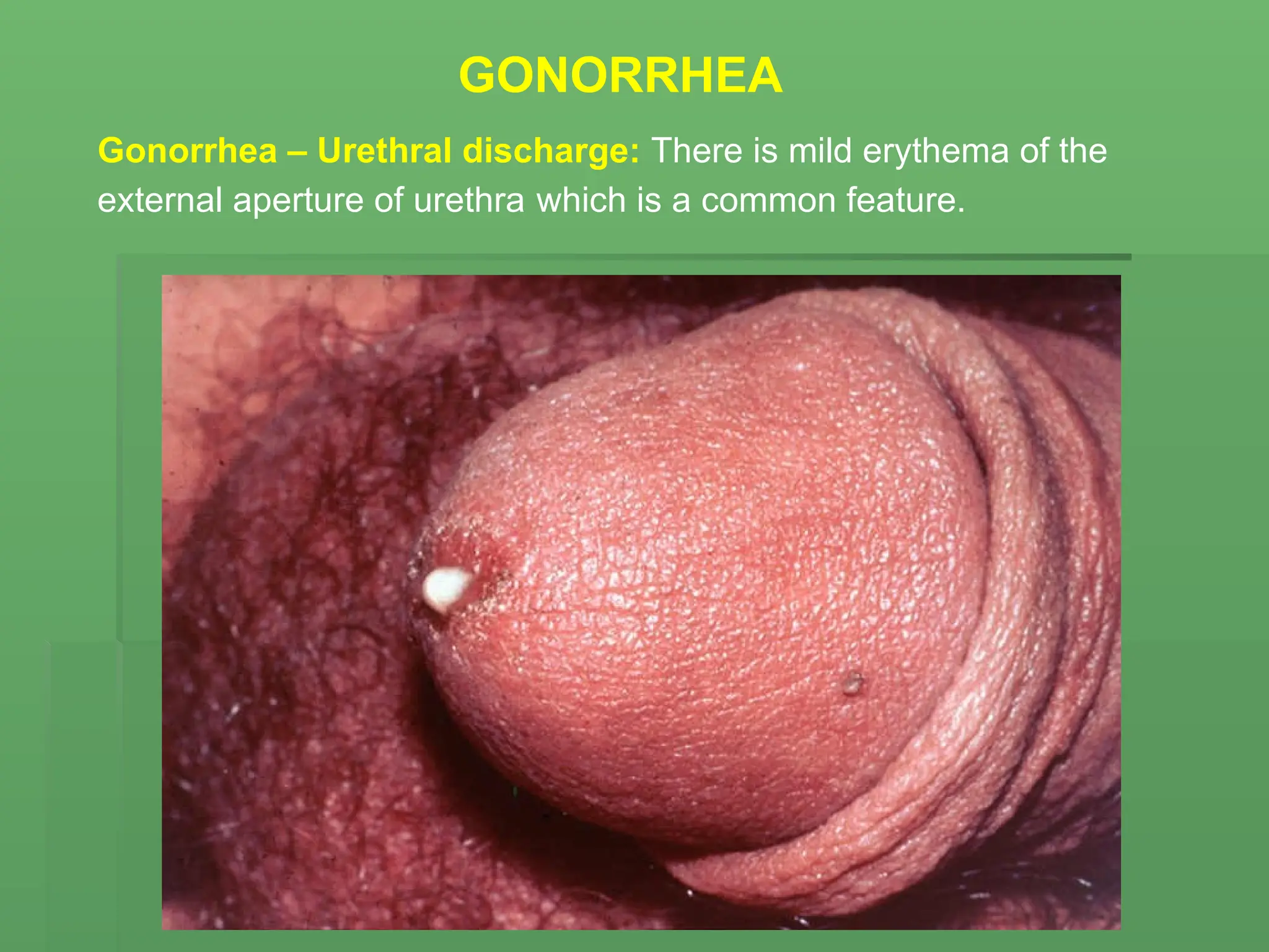 Gonorrhea – Urethral discharge: There is mild erythema of the
external aperture of urethra which is a common feature.
GONORRHEA
 