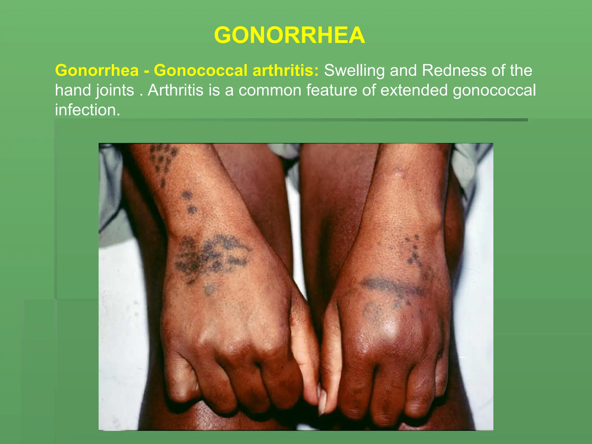 Gonorrhea - Gonococcal arthritis: Swelling and Redness of the
hand joints . Arthritis is a common feature of extended gonococcal
infection.
GONORRHEA
 