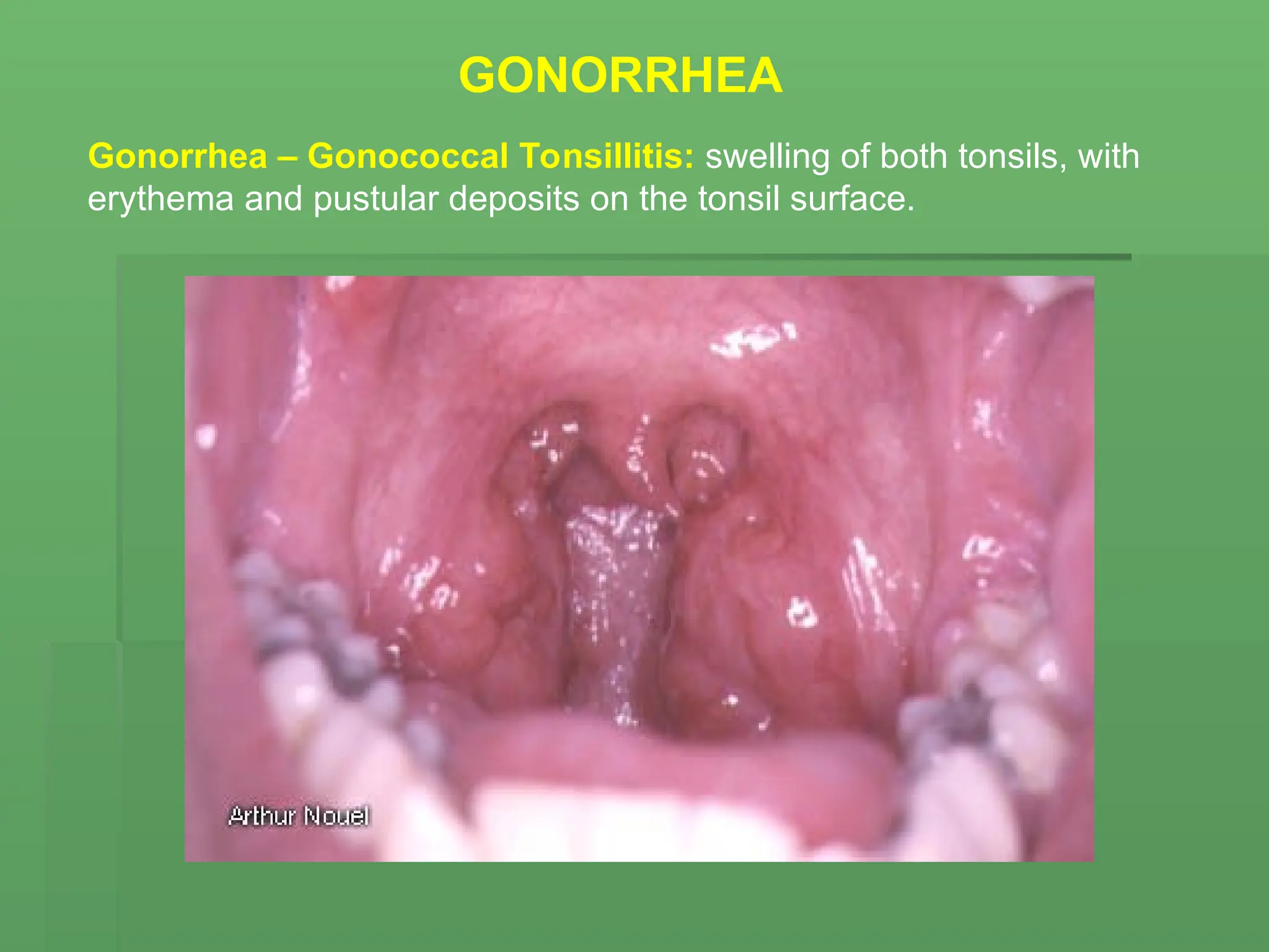 GONORRHEA
Gonorrhea – Gonococcal Tonsillitis: swelling of both tonsils, with
erythema and pustular deposits on the tonsil surface.
 