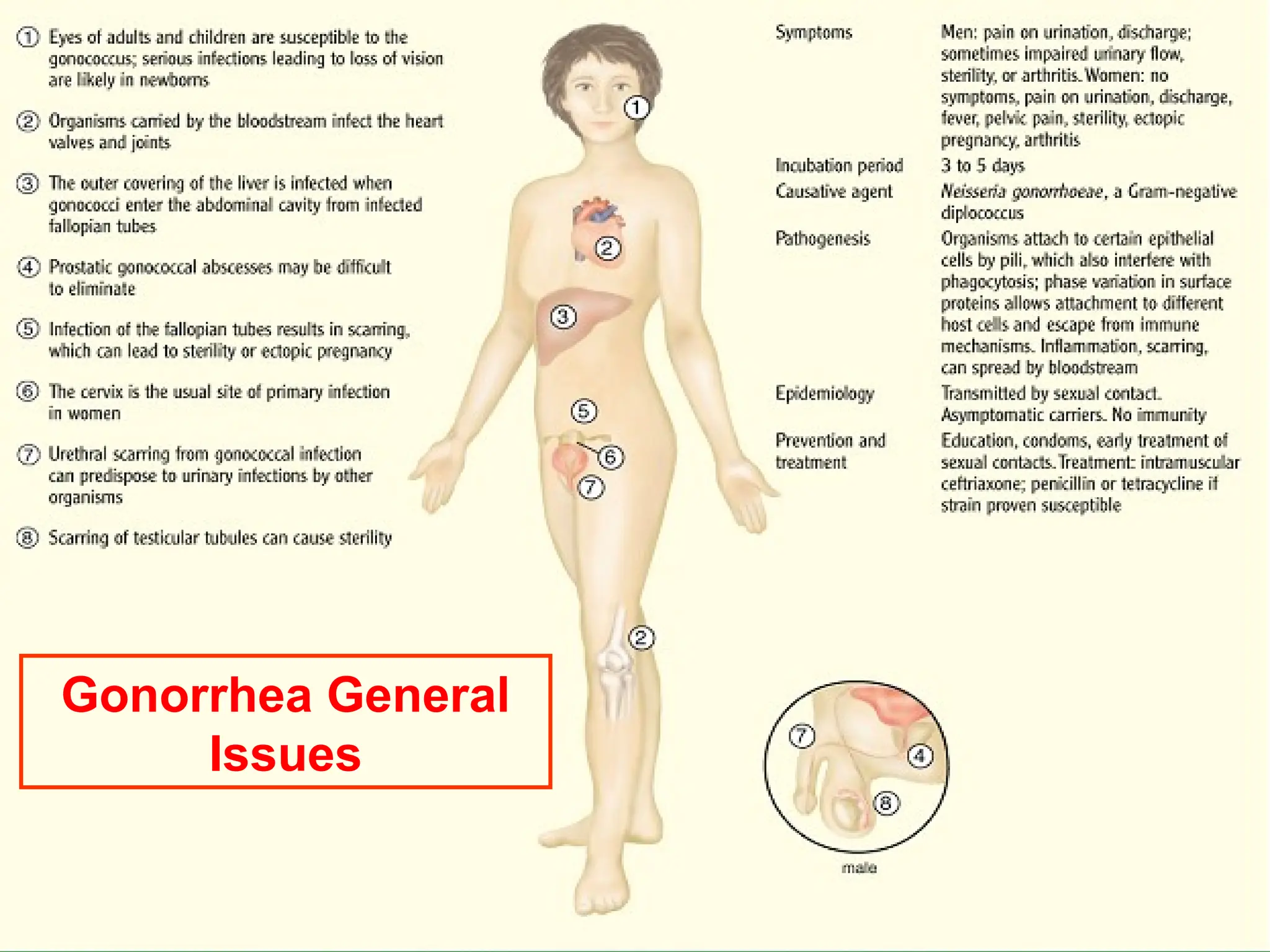 Gonorrhea General
Issues
 