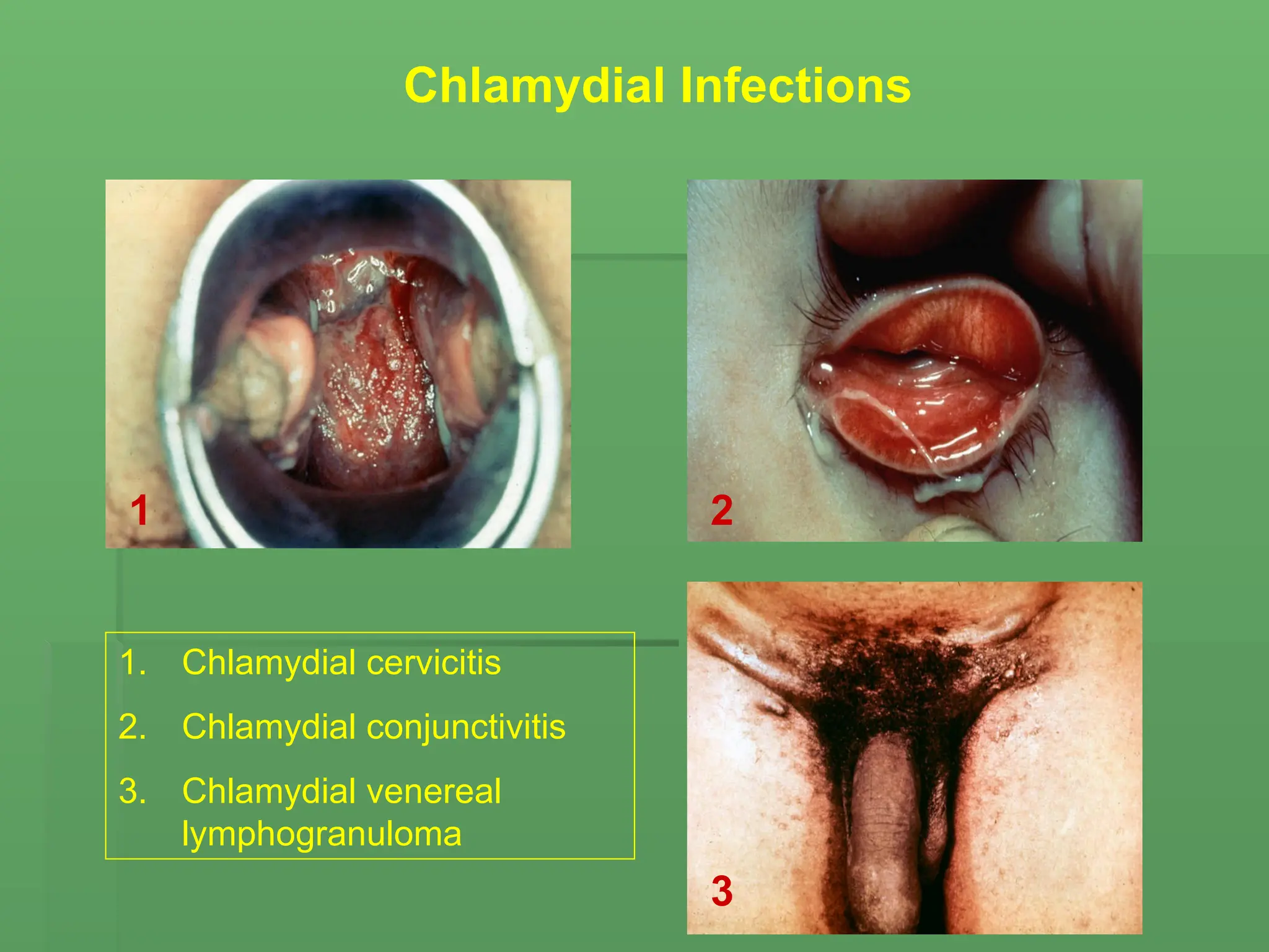 Chlamydial Infections
1 2
3
1. Chlamydial cervicitis
2. Chlamydial conjunctivitis
3. Chlamydial venereal
lymphogranuloma
 