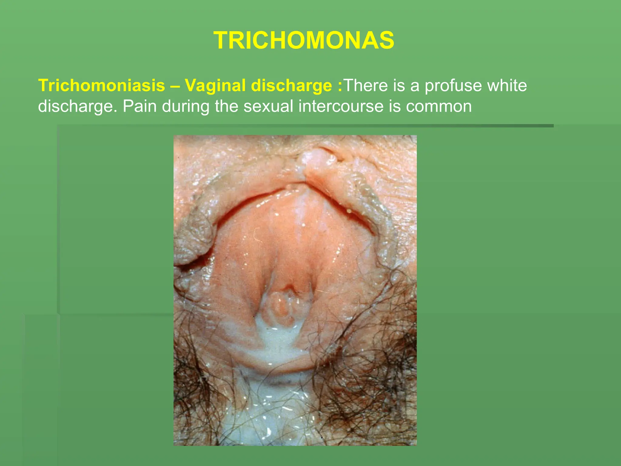 Trichomoniasis – Vaginal discharge :There is a profuse white
discharge. Pain during the sexual intercourse is common
TRICHOMONAS
 