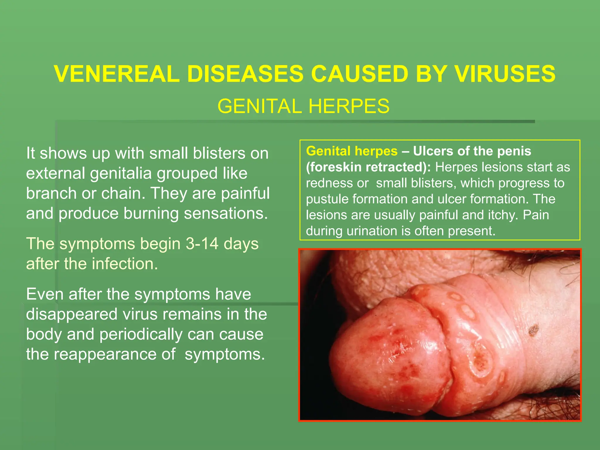 VENEREAL DISEASES CAUSED BY VIRUSES
GENITAL HERPES
It shows up with small blisters on
external genitalia grouped like
branch or chain. They are painful
and produce burning sensations.
The symptoms begin 3-14 days
after the infection.
Even after the symptoms have
disappeared virus remains in the
body and periodically can cause
the reappearance of symptoms.
Genital herpes – Ulcers of the penis
(foreskin retracted): Herpes lesions start as
redness or small blisters, which progress to
pustule formation and ulcer formation. The
lesions are usually painful and itchy. Pain
during urination is often present.
 