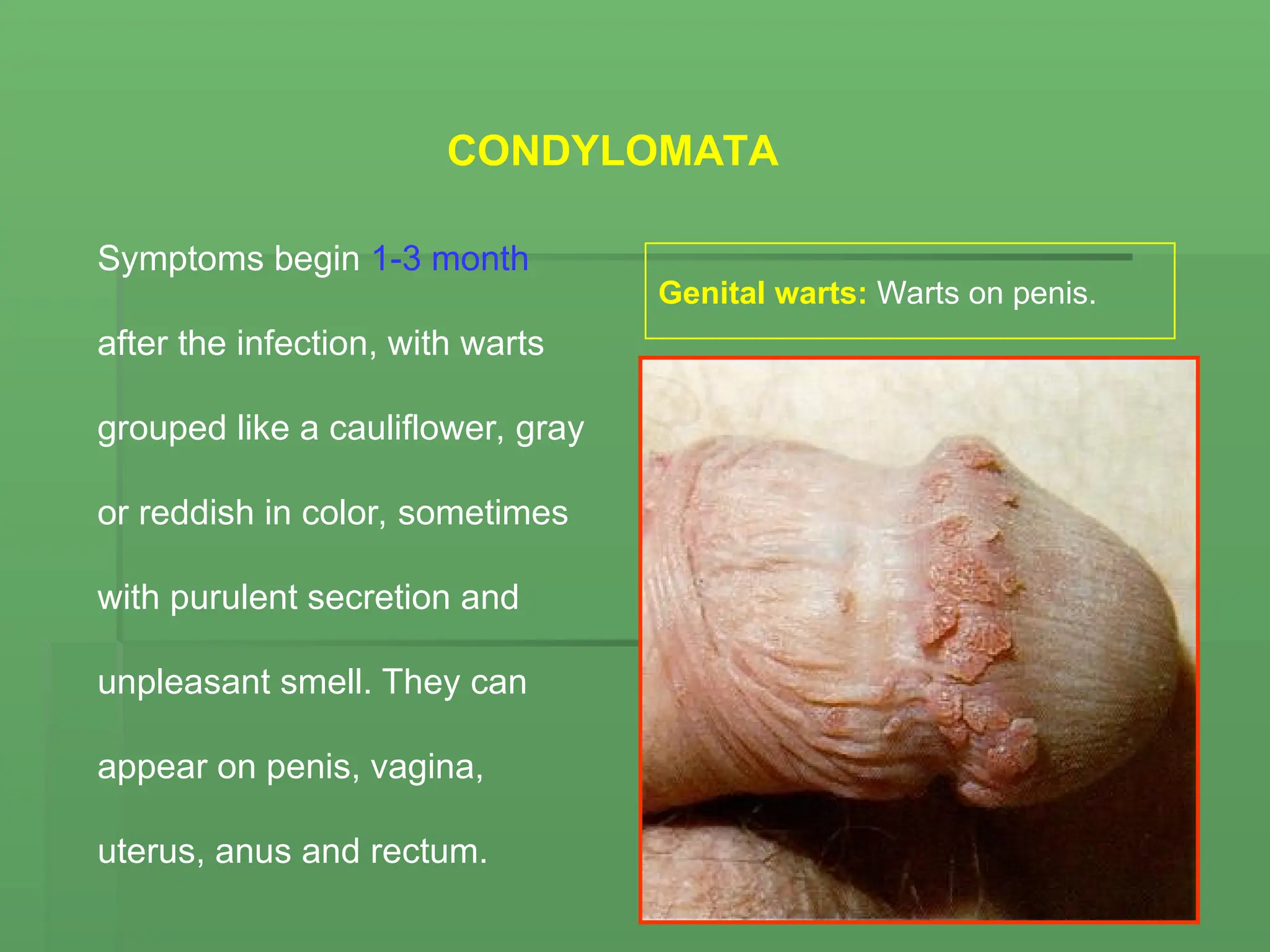CONDYLOMATA
Symptoms begin 1-3 month
after the infection, with warts
grouped like a cauliflower, gray
or reddish in color, sometimes
with purulent secretion and
unpleasant smell. They can
appear on penis, vagina,
uterus, anus and rectum.
Genital warts: Warts on penis.
 