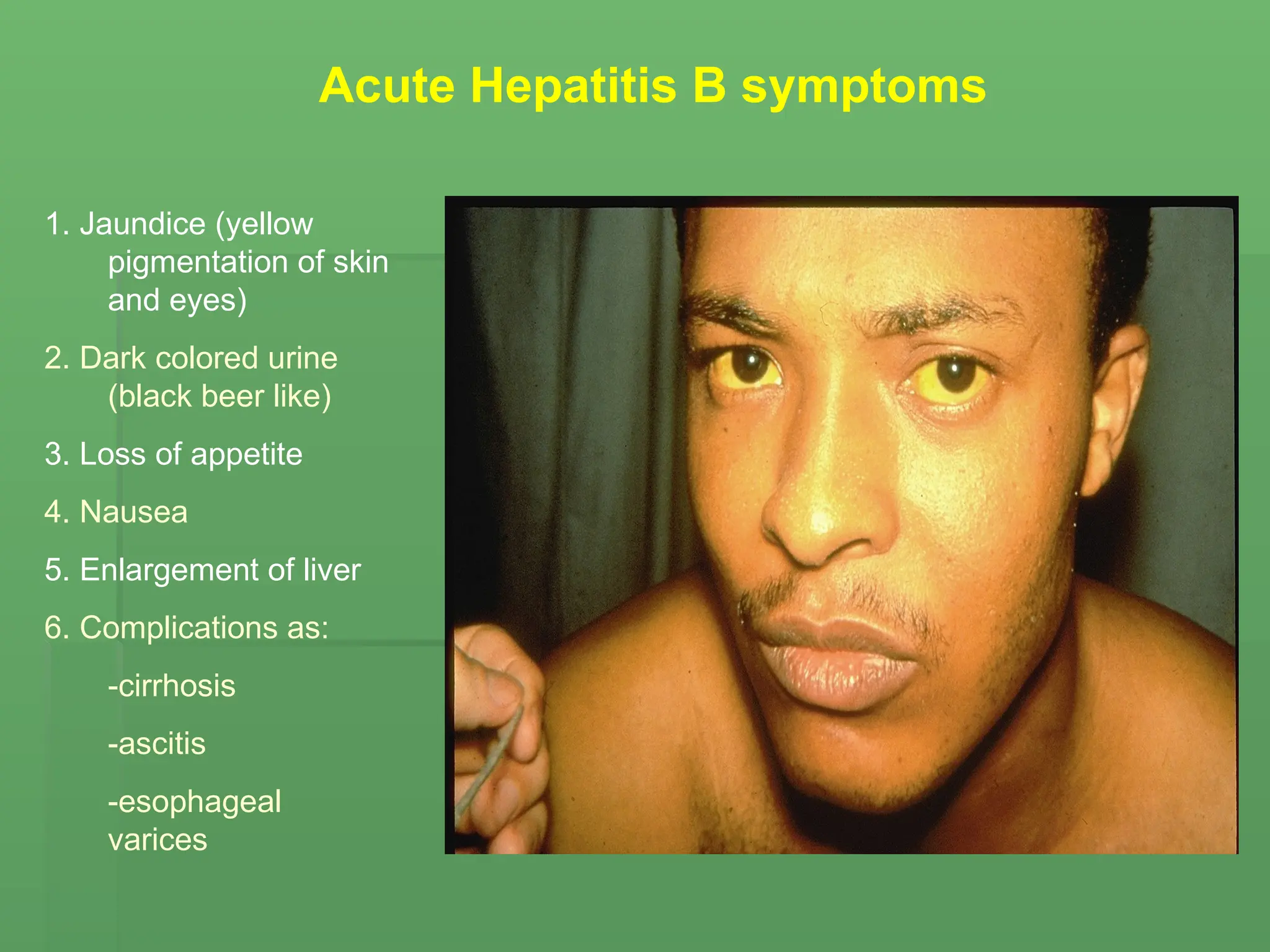 Acute Hepatitis B symptoms
1. Jaundice (yellow
pigmentation of skin
and eyes)
2. Dark colored urine
(black beer like)
3. Loss of appetite
4. Nausea
5. Enlargement of liver
6. Complications as:
-cirrhosis
-ascitis
-esophageal
varices
 