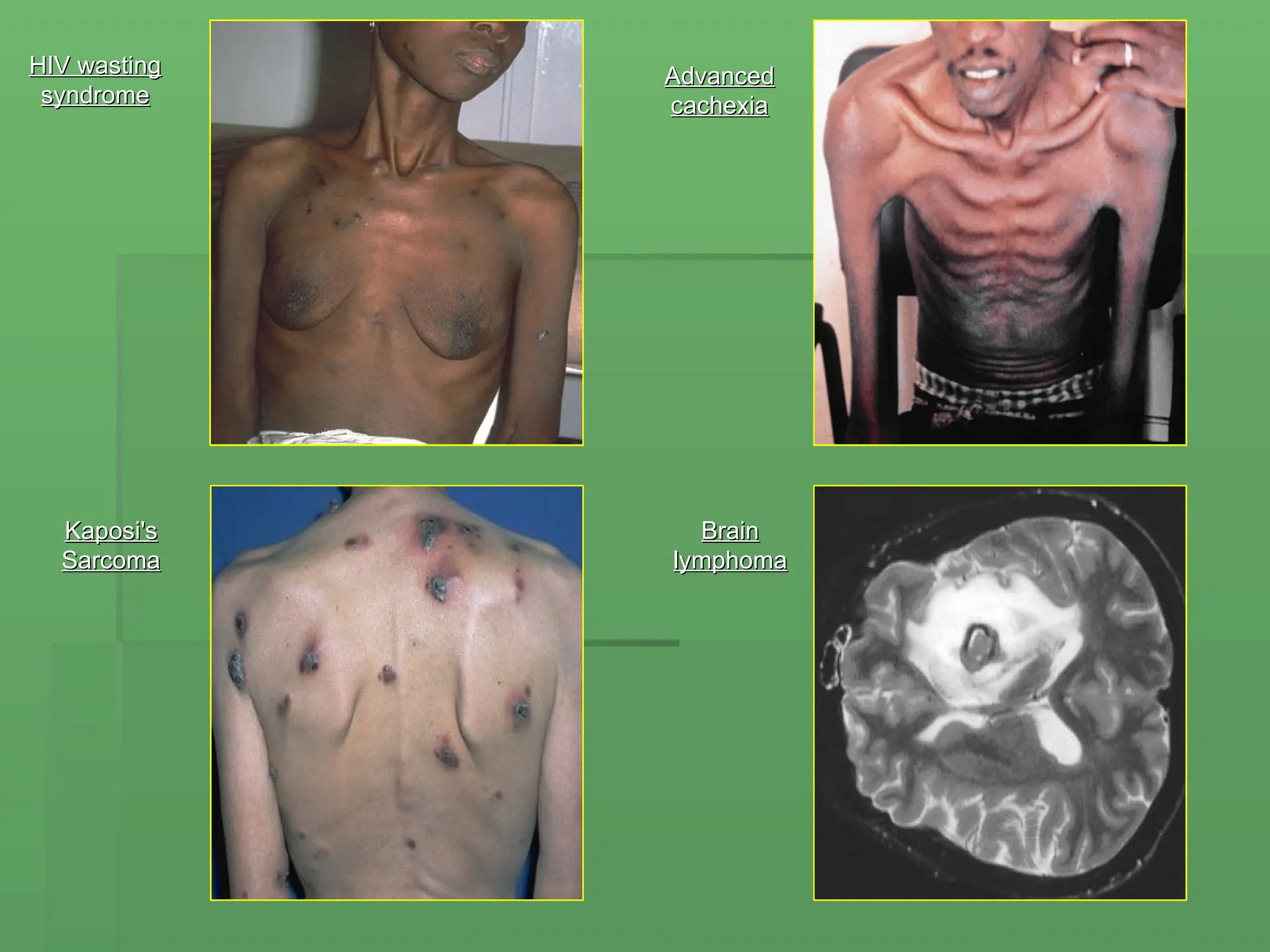 HIV wasting
HIV wasting
syndrome
syndrome
Kaposi's
Kaposi's
Sarcoma
Sarcoma
Advanced
Advanced
cachexia
cachexia
Brain
Brain
lymphoma
lymphoma
 
