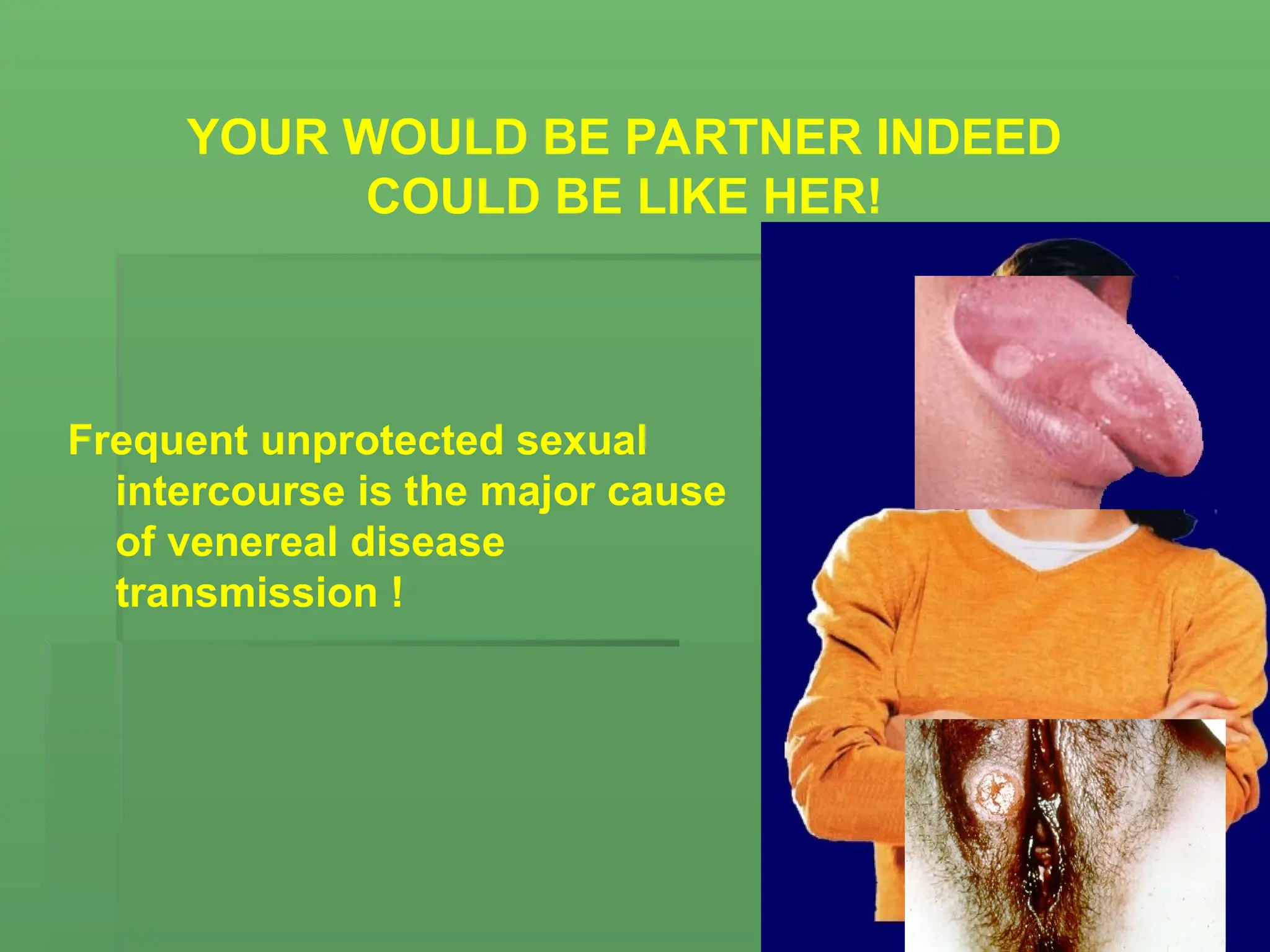 YOUR WOULD BE PARTNER INDEED
COULD BE LIKE HER!
Frequent unprotected sexual
intercourse is the major cause
of venereal disease
transmission !
 