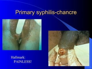 Primary syphilis-chancre Hallmark: PAINLESS! 