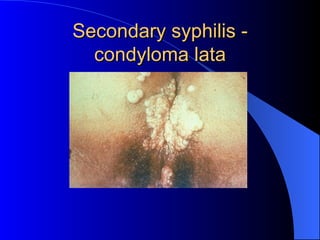 Secondary syphilis - condyloma lata 