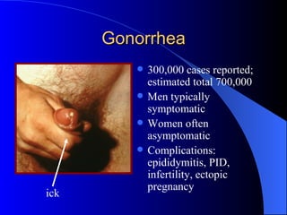 Gonorrhea 300,000 cases reported; estimated total 700,000 Men typically symptomatic Women often asymptomatic Complications: epididymitis, PID, infertility, ectopic pregnancy ick 