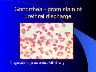 Gonorrhea - gram stain of urethral discharge Diagnosis by gram stain– MEN only 