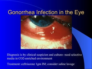 Gonorrhea Infection in the Eye Diagnosis is by clinical suspicion and culture- need selective media in CO2-enriched environment Treatment: ceftriazone 1gm IM; consider saline lavage 