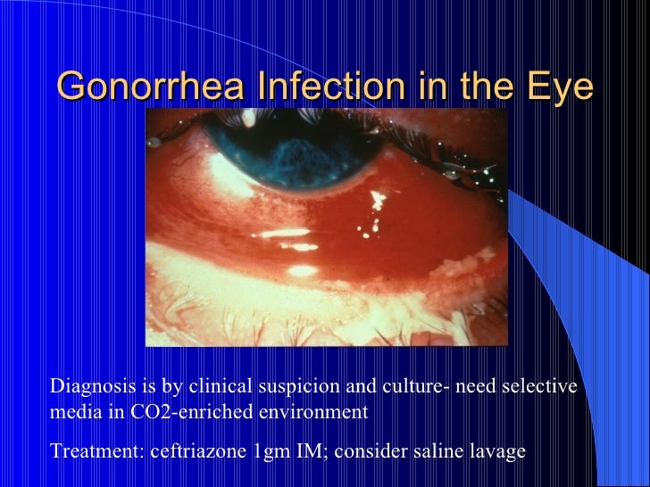 Sexually Transmitted Diseases