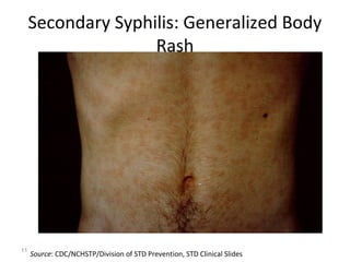 Syphilis Rash Torso Syndromic Approach to Sexually Transmitted Diseases | PPT