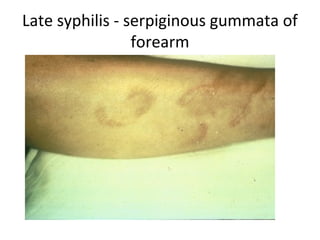Semga Infection Syndromic Approach to Sexually Transmitted Diseases | PPT