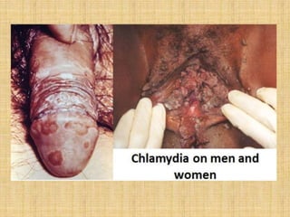 Sexually Transmitted Diseases