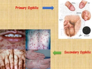 Sexually Transmitted Diseases
