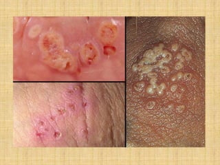 Sexually Transmitted Diseases