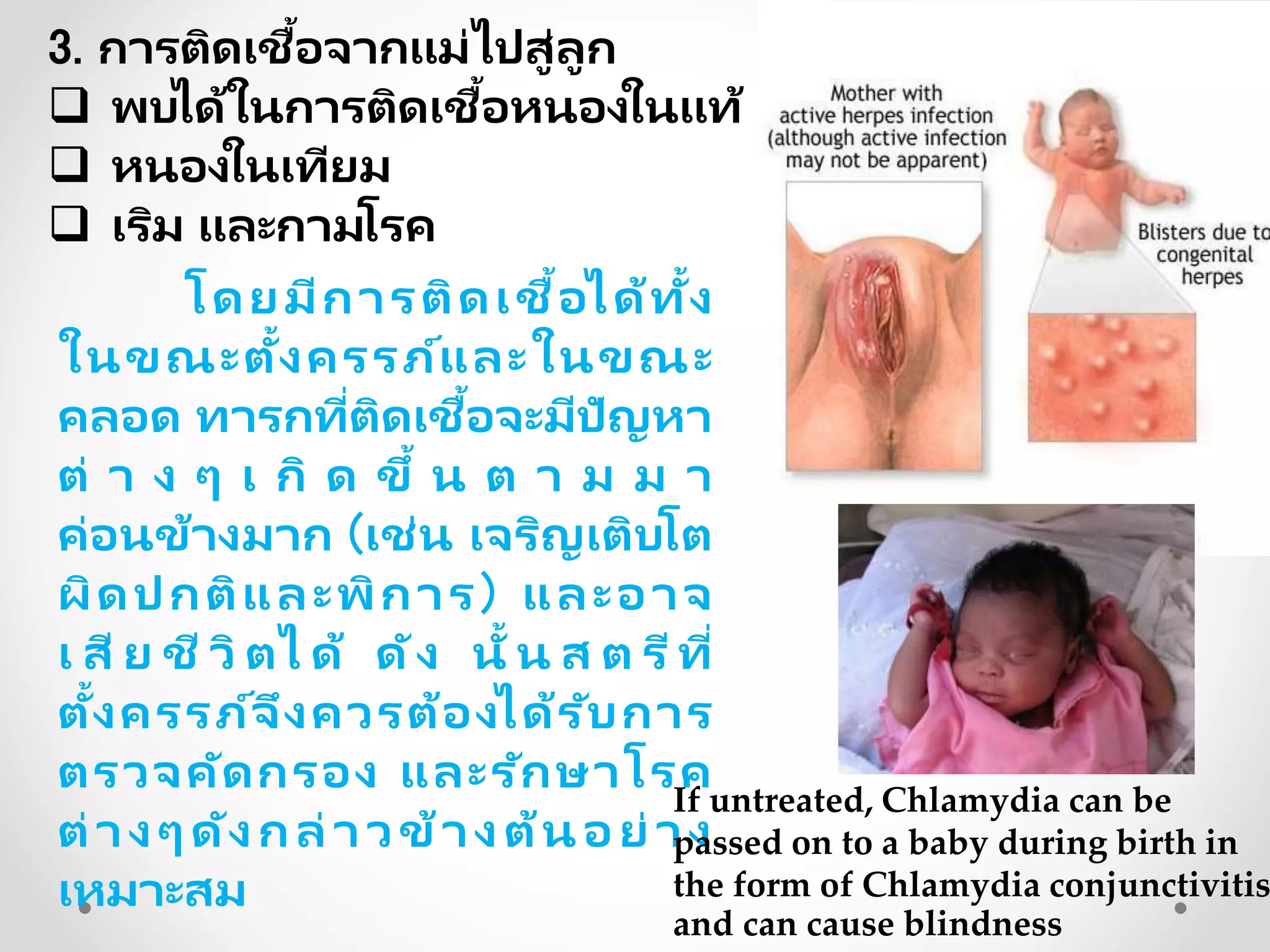 3. การติดเชื้อจากแม่ไปสู่ลูก
 พบได้ในการติดเชื้อหนองในแท้
 หนองในเทียม
 เริม และกามโรค
โดยมีการติดเชื้อได้ทั้ง
ในขณะตั้งครรภ์และในขณะ
คลอด ทารกที่ติดเชื้อจะมีปัญหา
ต่ า ง ๆ เ กิ ด ขึ้ น ต า ม ม า
ค่อนข้างมาก (เช่น เจริญเติบโต
ผิดปกติและพิการ) และอาจ
เ สี ย ชี วิ ตไ ด้ ดัง นั้ น ส ต รีที่
ตั้งครรภ์จึงควรต้องได้รับการ
ตรวจคัดกรอง และรักษาโรค
ต่างๆดังกล่าวข้างต้นอย่าง
เหมาะสม
If untreated, Chlamydia can be
passed on to a baby during birth in
the form of Chlamydia conjunctivitis
and can cause blindness
 