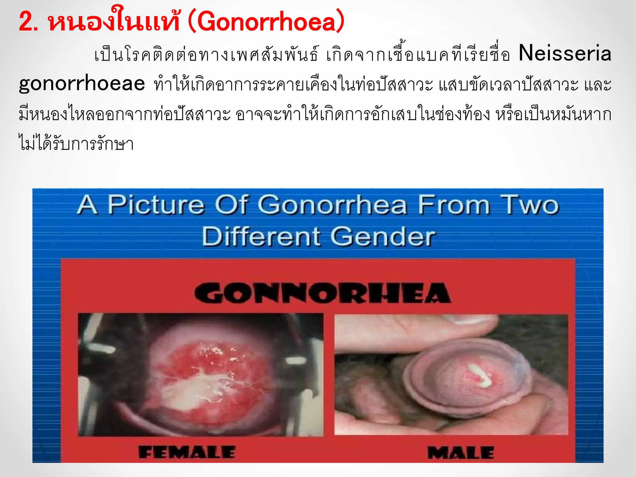 2. หนองในแท้ (Gonorrhoea)
เป็นโรคติดต่อทางเพศสัมพันธ์ เกิดจากเชื้อแบคทีเรียชื่อ Neisseria
gonorrhoeae ทาให้เกิดอาการระคายเคืองในท่อปัสสาวะ แสบขัดเวลาปัสสาวะ และ
มีหนองไหลออกจากท่อปัสสาวะ อาจจะทาให้เกิดการอักเสบในช่องท้อง หรือเป็นหมันหาก
ไม่ได้รับการรักษา
 