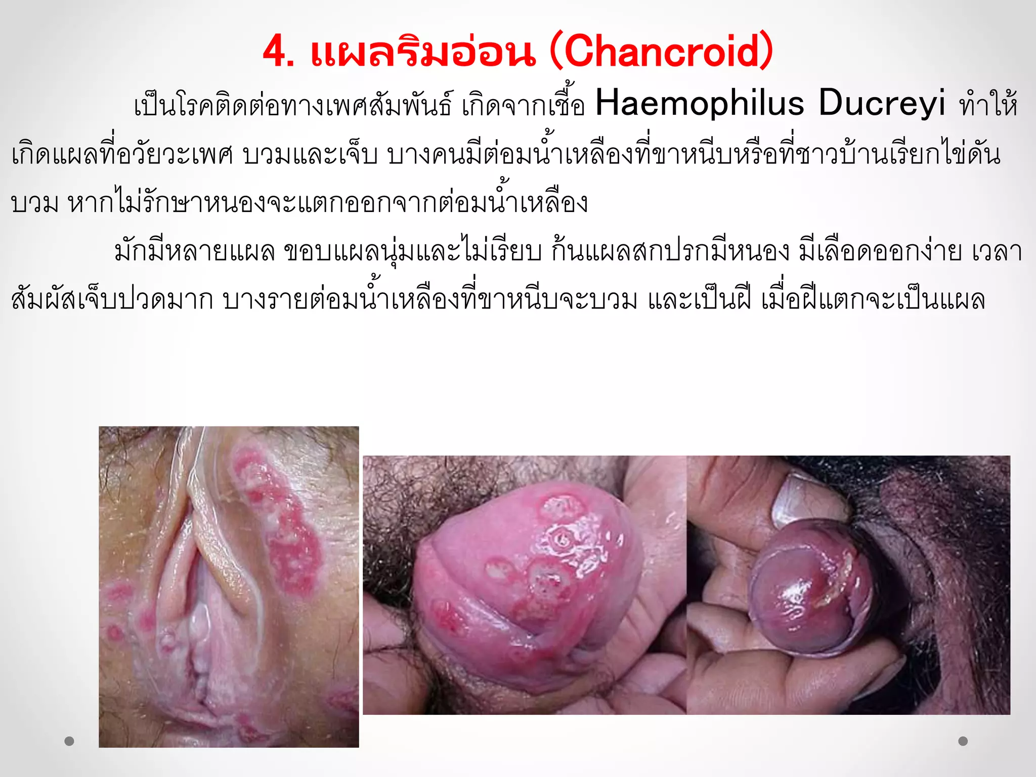 4. แผลริมอ่อน (Chancroid)
เป็นโรคติดต่อทางเพศสัมพันธ์ เกิดจากเชื้อ Haemophilus Ducreyi ทาให้
เกิดแผลที่อวัยวะเพศ บวมและเจ็บ บางคนมีต่อมน้าเหลืองที่ขาหนีบหรือที่ชาวบ้านเรียกไข่ดัน
บวม หากไม่รักษาหนองจะแตกออกจากต่อมน้าเหลือง
มักมีหลายแผล ขอบแผลนุ่มและไม่เรียบ ก้นแผลสกปรกมีหนอง มีเลือดออกง่าย เวลา
สัมผัสเจ็บปวดมาก บางรายต่อมน้าเหลืองที่ขาหนีบจะบวม และเป็นฝี เมื่อฝีแตกจะเป็นแผล
 