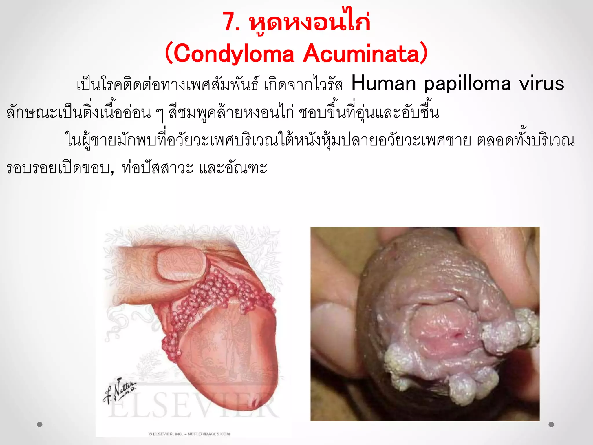 7. หูดหงอนไก่
(Condyloma Acuminata)
เป็นโรคติดต่อทางเพศสัมพันธ์ เกิดจากไวรัส Human papilloma virus
ลักษณะเป็นติ่งเนื้ออ่อน ๆ สีชมพูคล้ายหงอนไก่ ชอบขึ้นที่อุ่นและอับชื้น
ในผู้ชายมักพบที่อวัยวะเพศบริเวณใต้หนังหุ้มปลายอวัยวะเพศชาย ตลอดทั้งบริเวณ
รอบรอยเปิดขอบ, ท่อปัสสาวะ และอัณฑะ
 