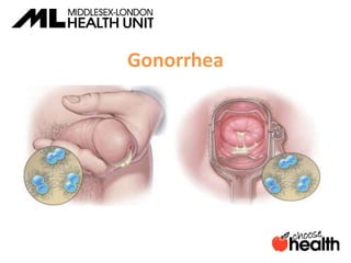 Gonorrhea
 