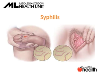 Syphilis
 