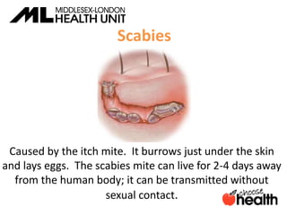 Scabies
Caused by the itch mite. It burrows just under the skin
and lays eggs. The scabies mite can live for 2-4 days away
from the human body; it can be transmitted without
sexual contact.
 