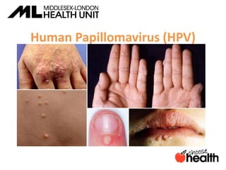 Human Papillomavirus (HPV)
 