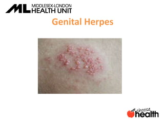 Genital Herpes
 