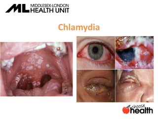 Chlamydia
 