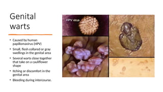 Genital
warts
• Caused by human
papillomavirus (HPV)
• Small, flesh collared or gray
swellings in the genital area
• Several warts close together
that take on a cauliflower
shape
• Itching or discomfort in the
genital area
• Bleeding during intercourse.
 