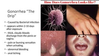 Gonorrhea “The
Drip”
• - Caused by Bacterial infection.
• -appears within 2-10 days
after exposure
• - thick, cloudy bloody
discharge from the penis or
vagina.
• - pain or burning sensation
when urinating.
• - abnormal bleeding
• - anal itching
 