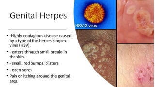 Genital Herpes
• -Highly contagious disease caused
by a type of the herpes simplex
virus (HSV).
• - enters through small breaks in
the skin.
• - small, red bumps, blisters
• - open sores
• Pain or itching around the genital
area.
 
