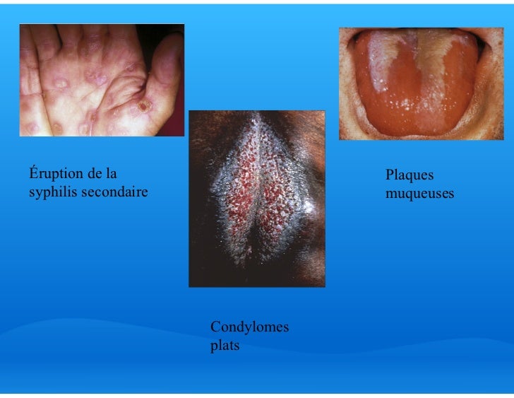 Si chez moi le psoriasis sera lui chez mon enfant
