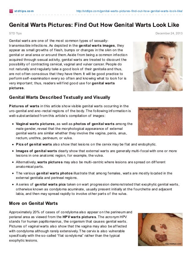 Genital Warts Pictures Find Out How Genital Warts Look Like