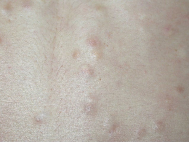 steatocystoma multiplex home remedy