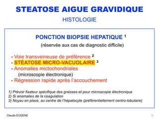 STEATOSE AIGUE GRAVIDIQUE
HISTOLOGIE
PONCTION BIOPSIE HEPATIQUE 1
(réservée aux cas de diagnostic difficile)
- Voie transveineuse de préférence 2
- STÉATOSE MICRO-VACUOLAIRE 3
- Anomalies mictochondriales 
(microscopie électronique)
- Régression rapide après l’accouchement
1) Prévoir fixateur spécifique des graisses et pour microscopie électronique
2) Si anomalies de la coagulation
3) Noyau en place, au centre de l’hépatocyte (préférentiellement centro-lobulaire)
12Claude EUGENE
 