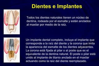 Todos los dientes naturales tienen un núcleo de
dentina, rodeada por el esmalte y están anclados
al maxilar por medio de la raíz.
Un implante dental completo, incluye el implante que
corresponde a la raíz del diente y la corona que imita
la apariencia del esmalte de los dientes adyacentes.
La corona está fijada al pilar o al poste que es el
equivalente de la dentina natural. El poste o pilar está
unido al implante de titanio anclado en el maxilar
actuando como la raíz del diente reemplazado.
Dientes e Implantes
 