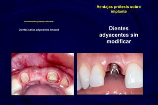 Inconvenientes prótesis tradicional
Dientes sanos adyacentes limados
Ventajas prótesis sobre
implante
Dientes
adyacentes sin
modificar
 