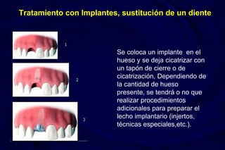 Se coloca un implante en el
hueso y se deja cicatrizar con
un tapón de cierre o de
cicatrización, Dependiendo de
la cantidad de hueso
presente, se tendrá o no que
realizar procedimientos
adicionales para preparar el
lecho implantario (injertos,
técnicas especiales,etc.).
Tratamiento con Implantes, sustitución de un diente
 