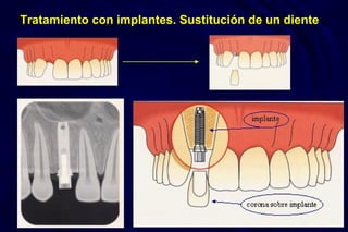Tratamiento con implantes. Sustitución de un diente
implante
corona sobre implante
 