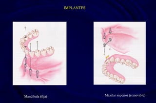 IMPLANTES
Mandíbula (fija) Maxilar superior (removible)
 