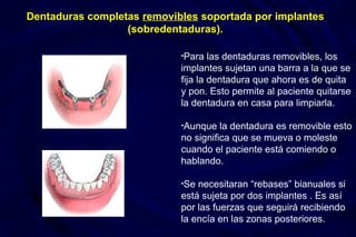 Dentaduras completas removibles soportada por implantes
(sobredentaduras).
•Para las dentaduras removibles, los
implantes sujetan una barra a la que se
fija la dentadura que ahora es de quita
y pon. Esto permite al paciente quitarse
la dentadura en casa para limpiarla.
•Aunque la dentadura es removible esto
no significa que se mueva o moleste
cuando el paciente está comiendo o
hablando.
•Se necesitaran “rebases” bianuales si
está sujeta por dos implantes . Es así
por las fuerzas que seguirá recibiendo
la encía en las zonas posteriores.
 