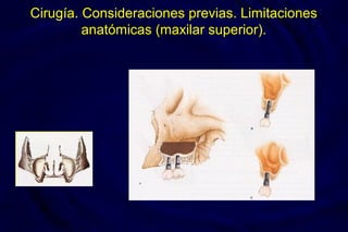 Cirugía. Consideraciones previas. Limitaciones
anatómicas (maxilar superior).
 
