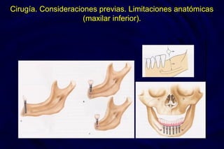 Cirugía. Consideraciones previas. Limitaciones anatómicas
(maxilar inferior).
 