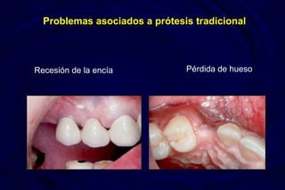 Problemas asociados a prótesis tradicional
Recesión de la encía Pérdida de hueso
 