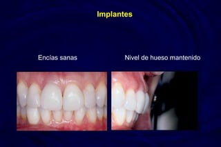 Implantes
Encías sanas Nivel de hueso mantenido
 