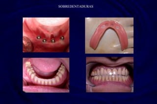 SOBREDENTADURAS
 